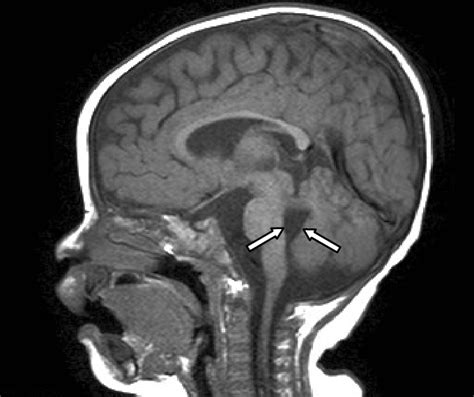 Cerebellar Vermis Anatomy Mri