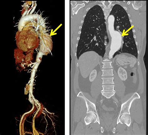 Thoracic aortic aneurysm – Radiology Cases