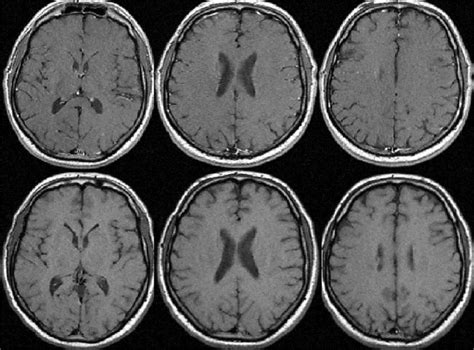 The measurement and clinical relevance of brain atrophy in multiple sclerosis - The Lancet Neurology