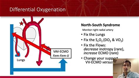 ECMO: VA ECMO For Dummies! - YouTube