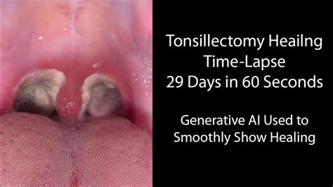 Healing Time Lapse After Tonsillectomy: 0-29 Days in 60 Seconds - YouTube