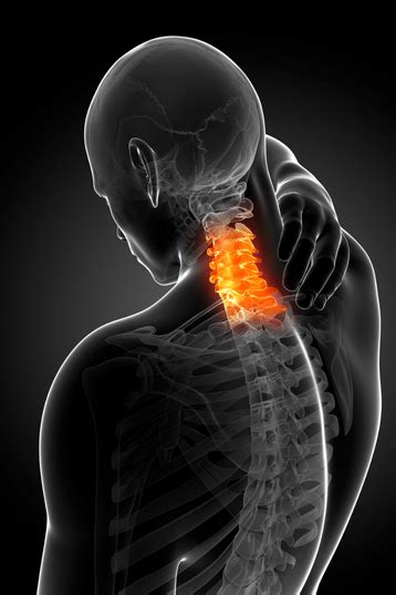 Cervical Radiculopathy Surgery: All You Need to Know