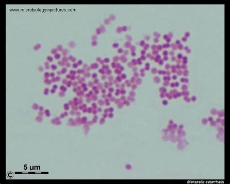 Moraxella catarrhalis Gram stain. Gram-positive diplococci under the microscope.