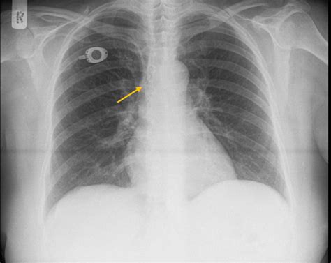 Porta Catheter Placement