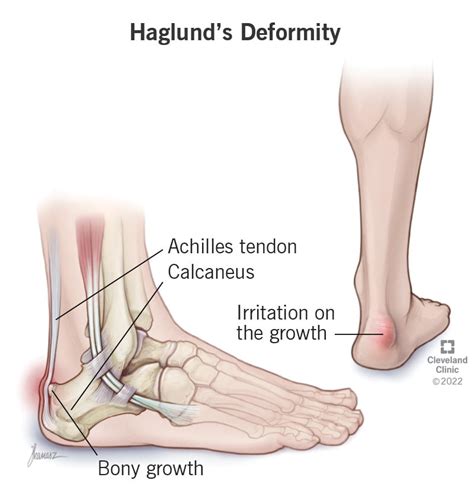 Solutions for Haglund's Deformity