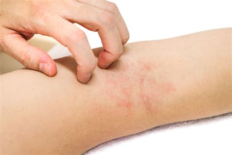 Dermatitis Rashes Eczema — Ducharme Dermatology