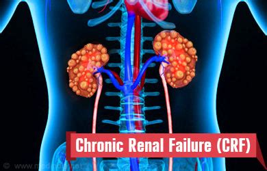 Chronic Renal Failure - Symptoms, Diagnosis, Complications, Treatment, Prevention