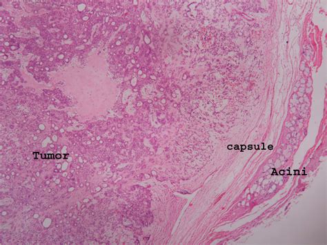 PLEOMORPHIC ADENOMA – Histopathology.guru