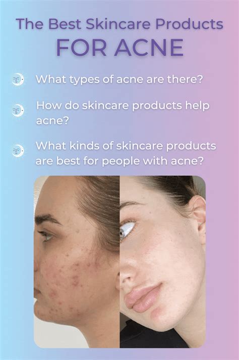 What types of acne are there? How do skincare products help acne? What kinds of skincare ...