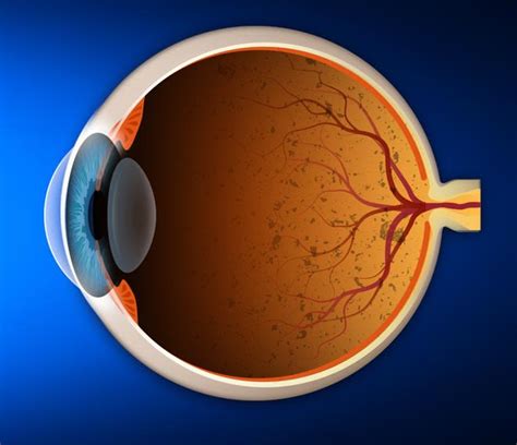 Retinitis Pigmentosa or RP: What is it? How is it treated?