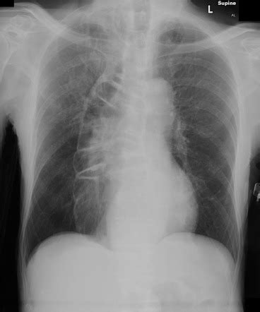 Colonic esophageal interposition | Radiology Case | Radiopaedia.org