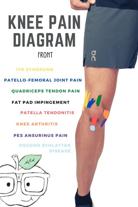 Knee Pain Diagram