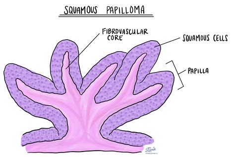 Squamous papilloma of the esophagus | MyPathologyReport.ca