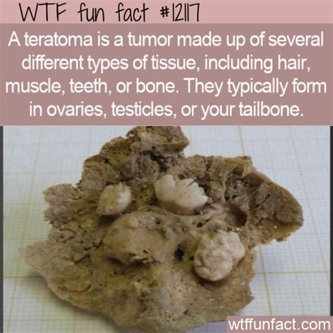 WTF Fun Fact - Teratoma