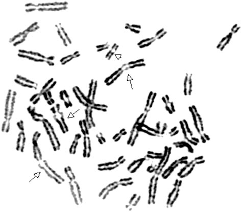 Expanding the mutation and clinical spectrum of Roberts syndrome ...