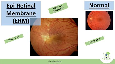 Epiretinal Membrane (ERM): What is it? Symptoms? Signs? Diagnosis? Treatment? I Dr Shaz Rehan ...