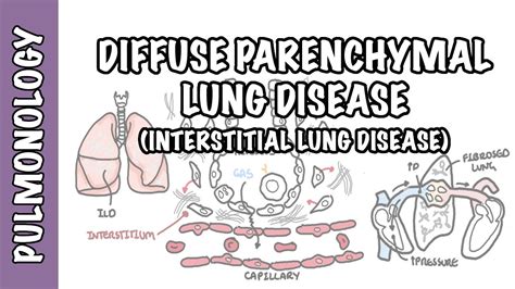 Interstitial Lung Disease (ILD) - Classification, pathophysiology, signs and symptoms - YouTube