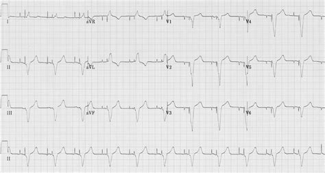 Pacemaker Rhythms – Normal Patterns • LITFL • ECG Library Diagnosis