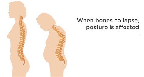 Calcium and Vitamin D - Irish Osteoporosis Society