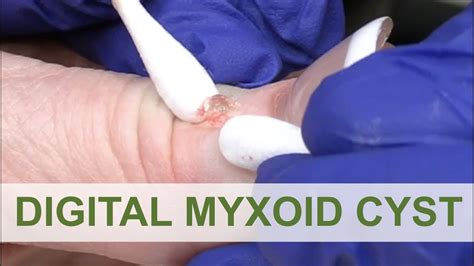 We love a Digital Myxoid Cyst | Dr. Derm - YouTube