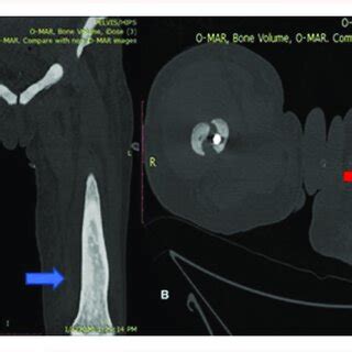 CT scan depicting a periprosthetic fracture of the right femur (yellow ...