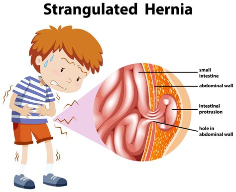 What is Hernia? and It’s Types | Doss India