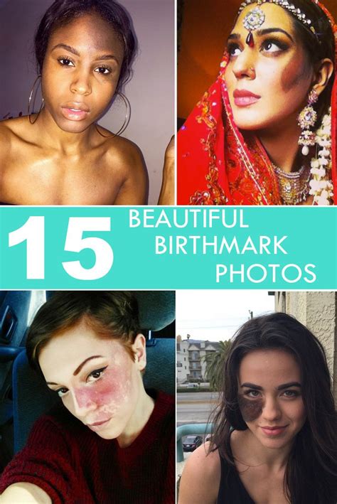 15 Photos That Prove That Birthmarks are Beautiful | Birthmark, Port wine stain birthmark, Port ...