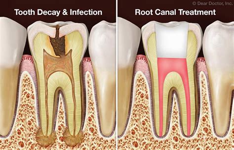 Root Canal Procedure at Lasting Smile Dental - Dentist in Washington