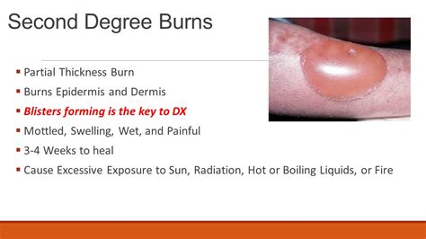 Second-degree burns: Blister burns- Causes & Effects