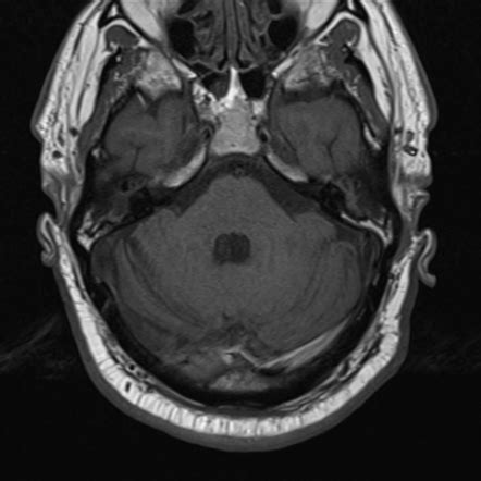 Congenital Cholesteatoma