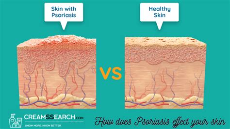 What is Psoriasis, Causes & Types? Find the Best Psoriasis Cream | Creams Search