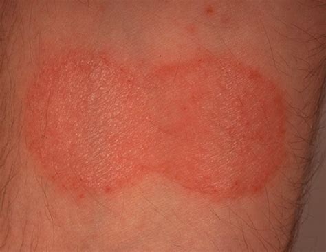 Mycosis Fungoides - Pictures, Staging, Symptoms, Treatment and Causes | HubPages