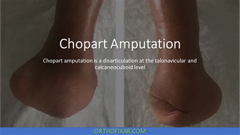 Chopart Amputation | OrthoFixar 2024