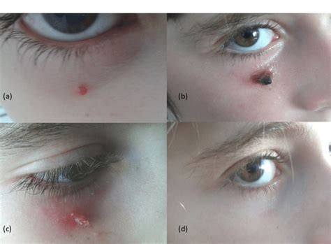 (a) Clinical aspect of the suborbital pyogenic granuloma prior to onset ...