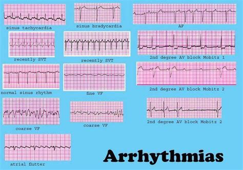 Pin on ECGs