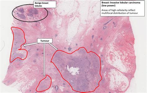 Breast – Carcinoma – NUS Pathweb :: NUS Pathweb