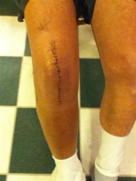 72 best Knee Replacement Scars images on Pinterest | Surgery, 1 and 3 ...