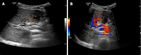 Paraumbilical Vein Ultrasound