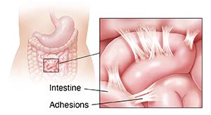 Understanding Lysis of Adhesions | Saint Luke's Health System