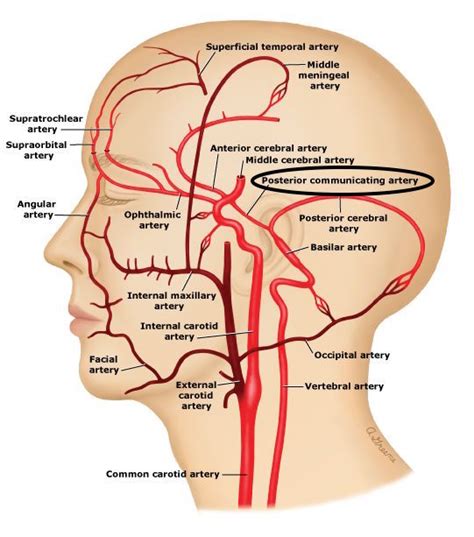 Posterior Communicating Artery - Stepwards