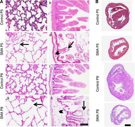 Emphysema Histology Comparison