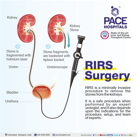 RIRS Surgery in Hyderabad – Indications, Side Effects and Benefits