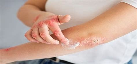 Skin Rashes: Causes, Symptoms, Red Flags and Treatment