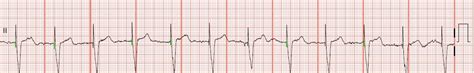 Float Nurse: EKG Rhythm Strips 56: Atrial Fibrillation