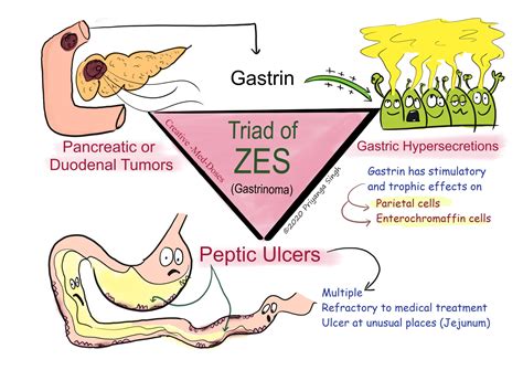 ZOLLINGER–ELLISON SYNDROME: ZES - Creative Med Doses