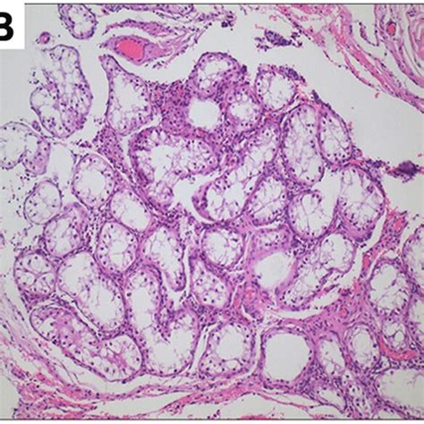 The micrograph of gonad histology of the patient (hematoxylin and eosin ...