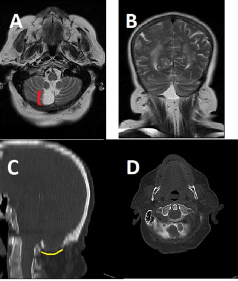 Figure 9 from Is it an arachnoid cyst or a mega cisterna magna? What to ...