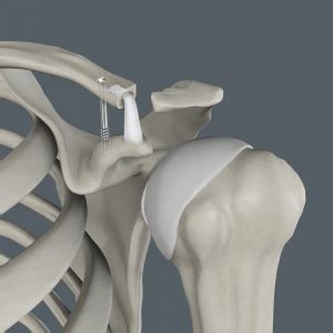 Acromioclavicular (AC) Joint Reconstruction | Advanced Orthopaedics & Sports Medicine ...