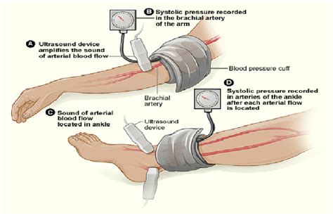 Arterial Doppler Study with ABI - Glendale Heart Institute | Cardiology | Best Cardiology Los ...