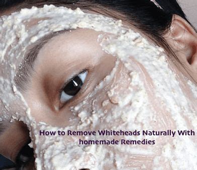 How to Remove Whiteheads acne with home remedies | Whitehead removal, Chin acne remedies, Whiteheads